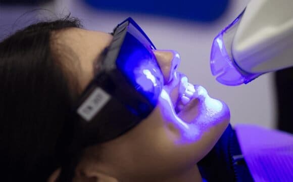 Teeth Whitening