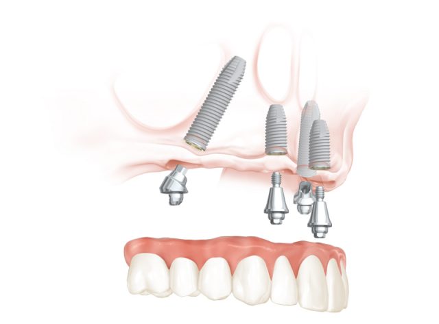 Discover the Incredible All-on-4 Dental Implants 3