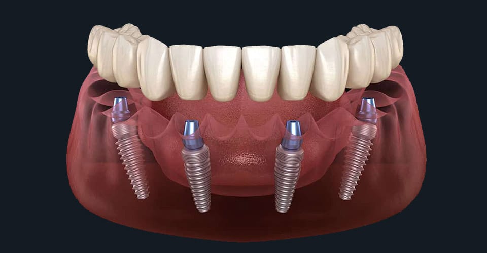Discover the Incredible All-on-4 Dental Implants 1