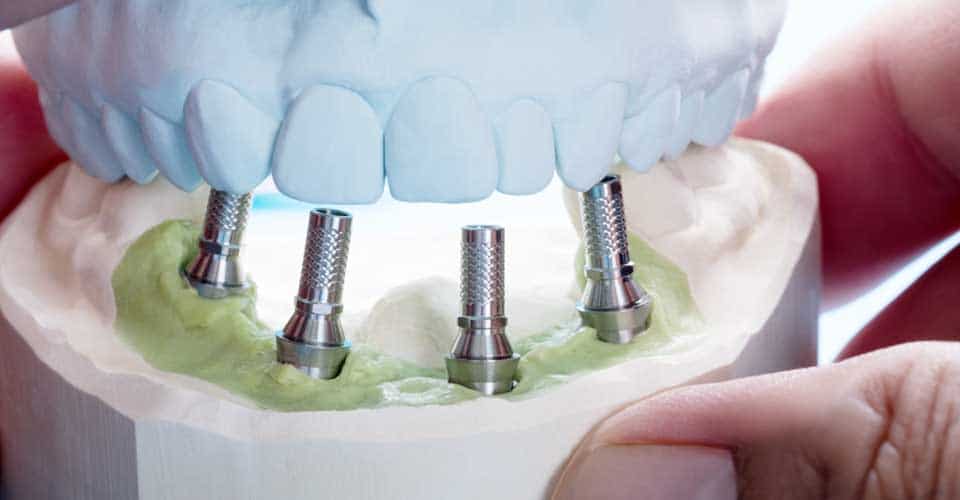 all on 4 dental implants in mexico