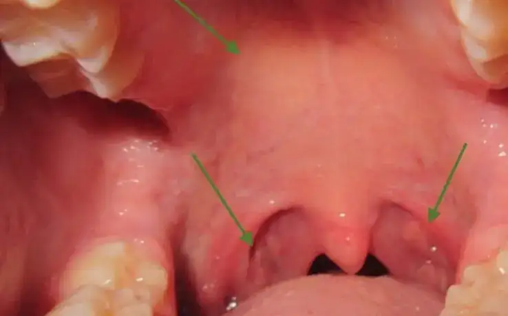 herpes inside roof of mouth