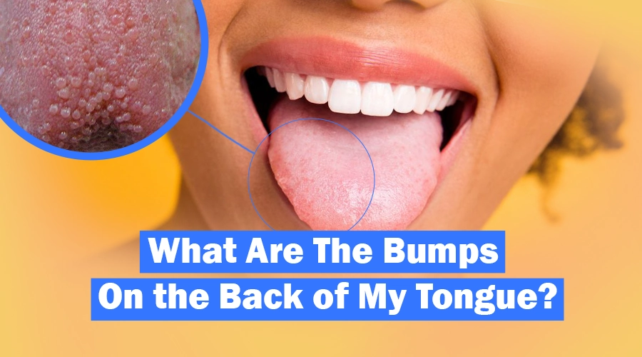 bumps on back of tongue