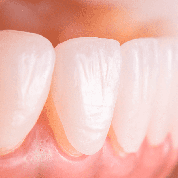 How Veneers Will Make Your 2022 So Much Better