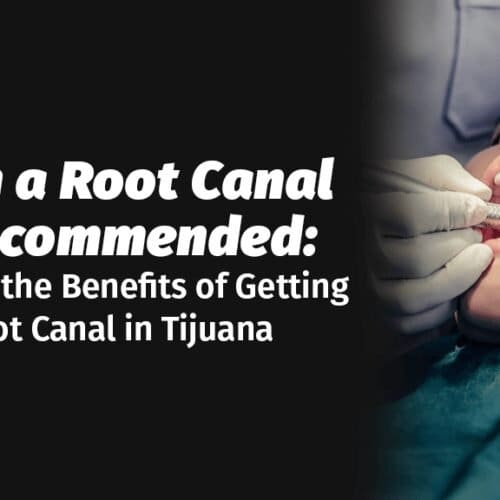 Understanding When a Root Canal is Recommended: Exploring the Benefits of Getting a Root Canal in Tijuana